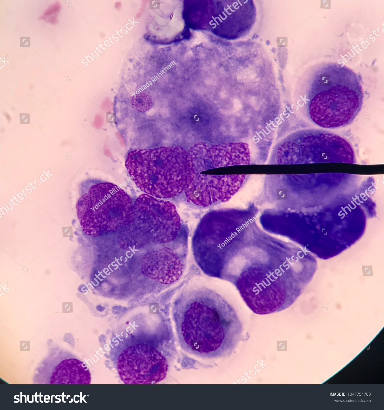 Malignant cell. Cell from Pleural effusion specimen.The biggest and deep blue cytoplasm.