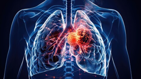 肺部肿瘤感染概念图
